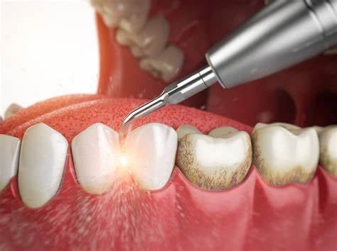 Teeth Cleaning: Dentist's Reasoning