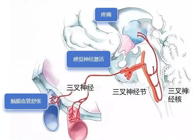 Managing Headaches Post-Respiratory Infections