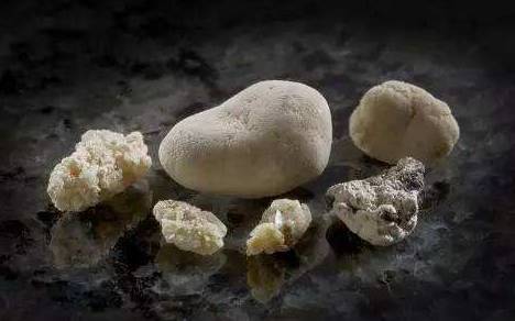 what causes kidney stones