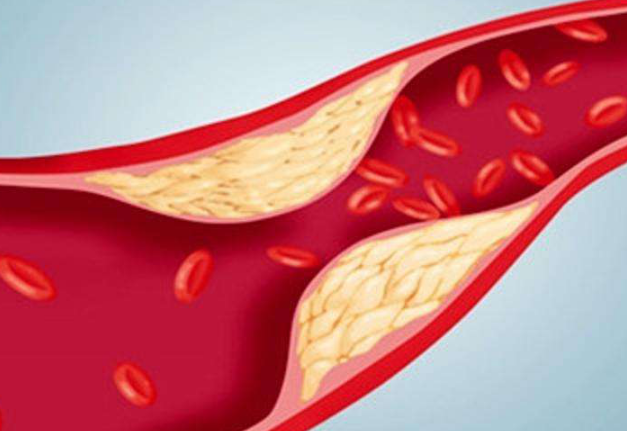 Symptoms of clogged arteries